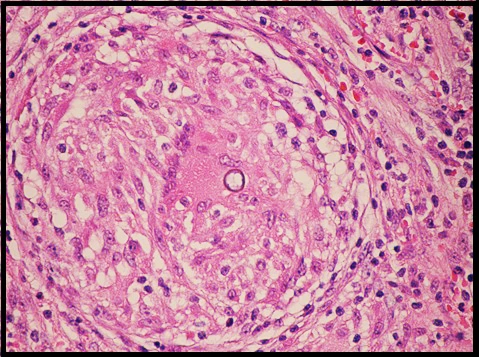 spherule_in_granuloma_2.jpg